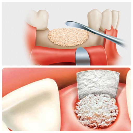 bone graft granulated