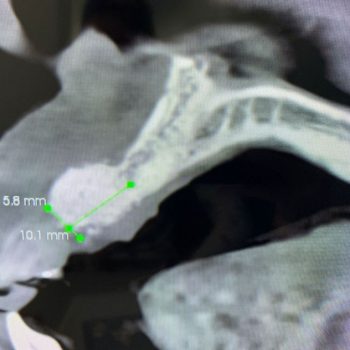 Bone regeneration using Integros Bone Plus XS Bone regeneration using Integros Bone Plus XS