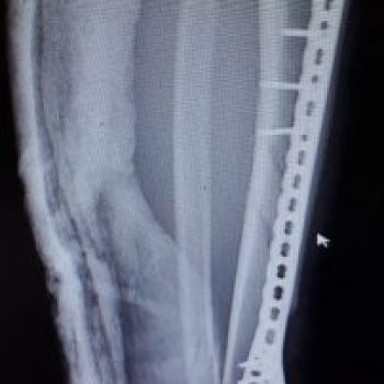 Distal Tibia Medial Distal Tibia Medial