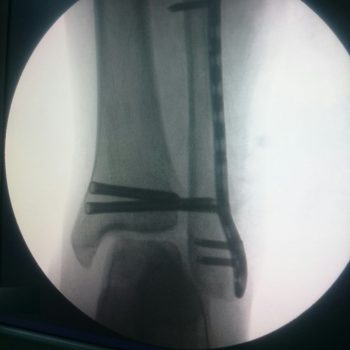 Fibula Locking Plate Fibula Locking Plate