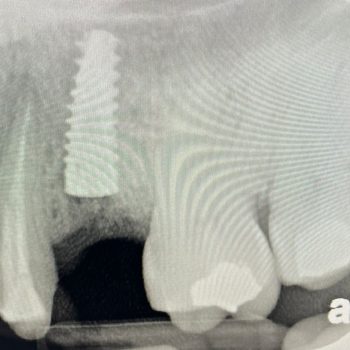 Inmediate load implant + Integros Bone Plus XS Inmediate load implant + Integros Bone Plus XS