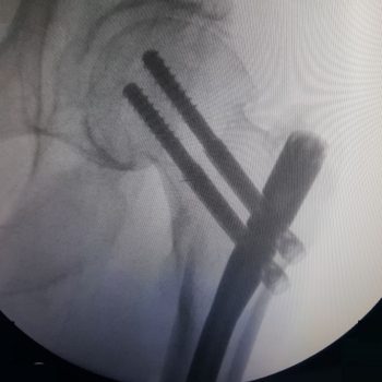 Proximal Femoral Nail Proximal Femoral Nail